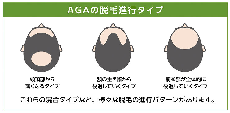男性に多い脱毛症AGA