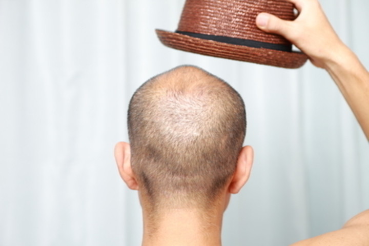 帽子やヘルメットなどの着用は脱毛症・薄毛・抜け毛・ハゲの原因にはなりません